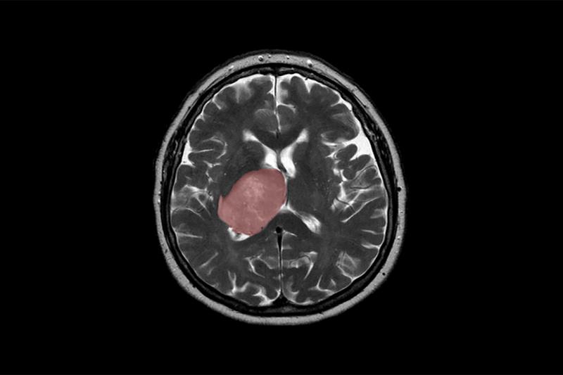 A brain scan shows a brain within the outline of the skull and a mass covering the centre left side.