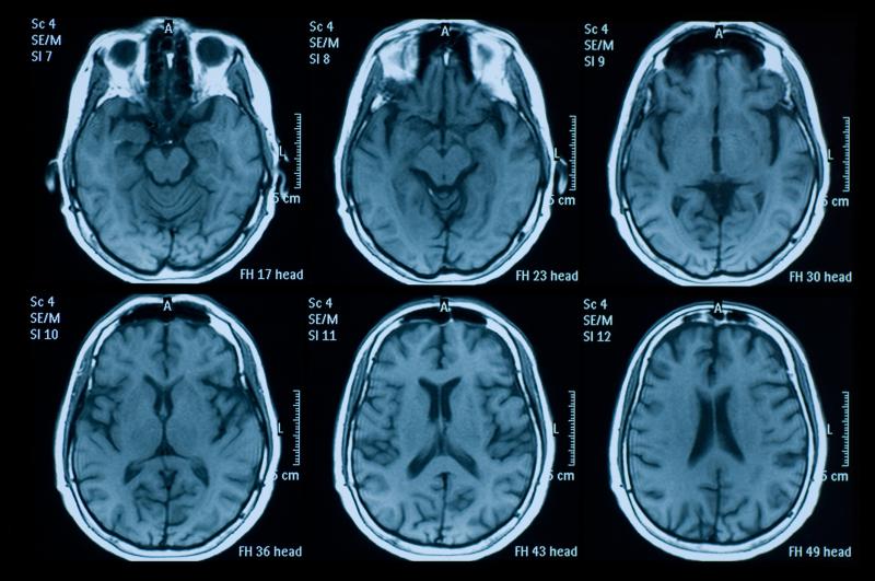 An MRI image showing six cross-sections of a brain.