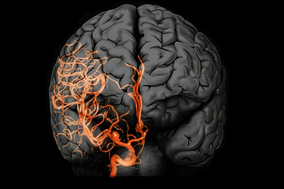 Brain aneurysm: A 3D computed tomography (CT) angiogram coupled with a magnetic resonance imaging (MRI) scan of the brain of a 38-year-old, showing a large aneurysm (bright, lower centre) of the right internal carotid artery 