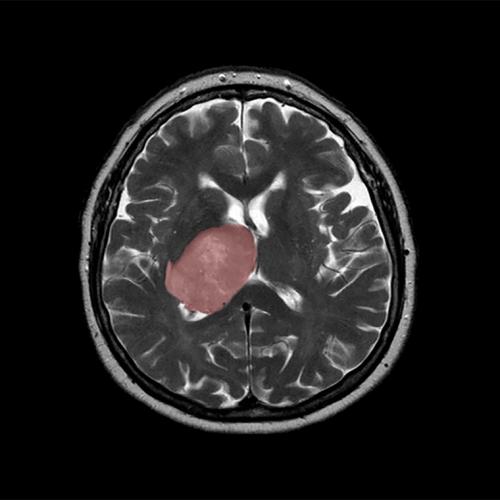 A brain scan shows a brain within the outline of the skull and a mass covering the centre left side.