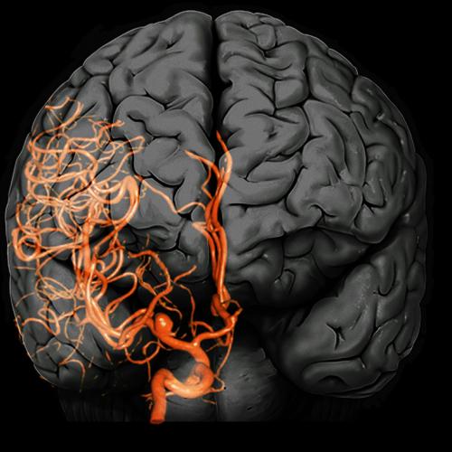 Brain aneurysm: A 3D computed tomography (CT) angiogram coupled with a magnetic resonance imaging (MRI) scan of the brain of a 38-year-old, showing a large aneurysm (bright, lower centre) of the right internal carotid artery 